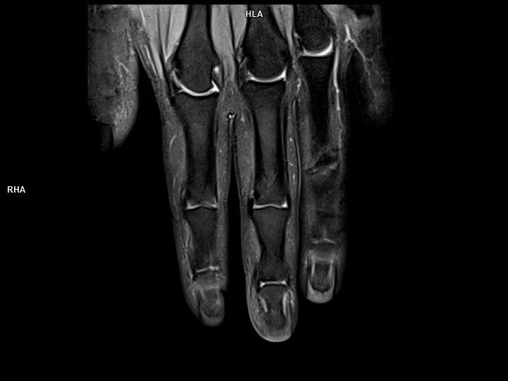 Coronal PD FS-MAGNETOM Lumina