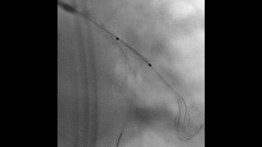 Siemens ARTIS Q.zen — CLEARstent Live: стент виден при установке