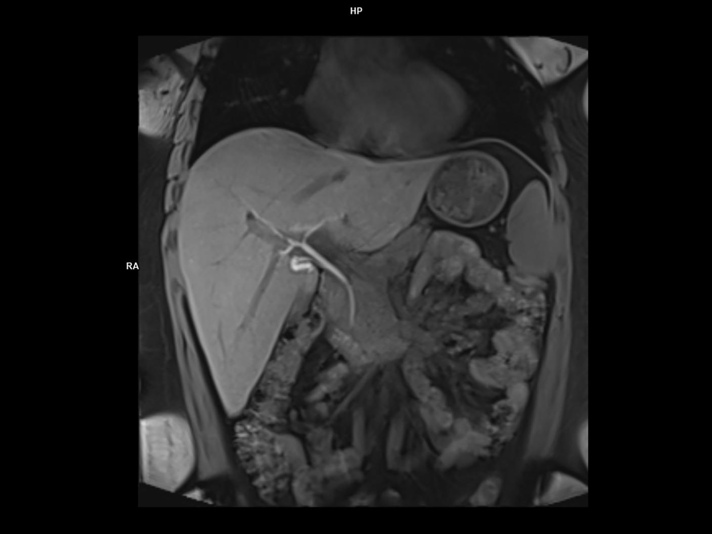 Coronal Vibe Dixon-MAGNETOM Vida