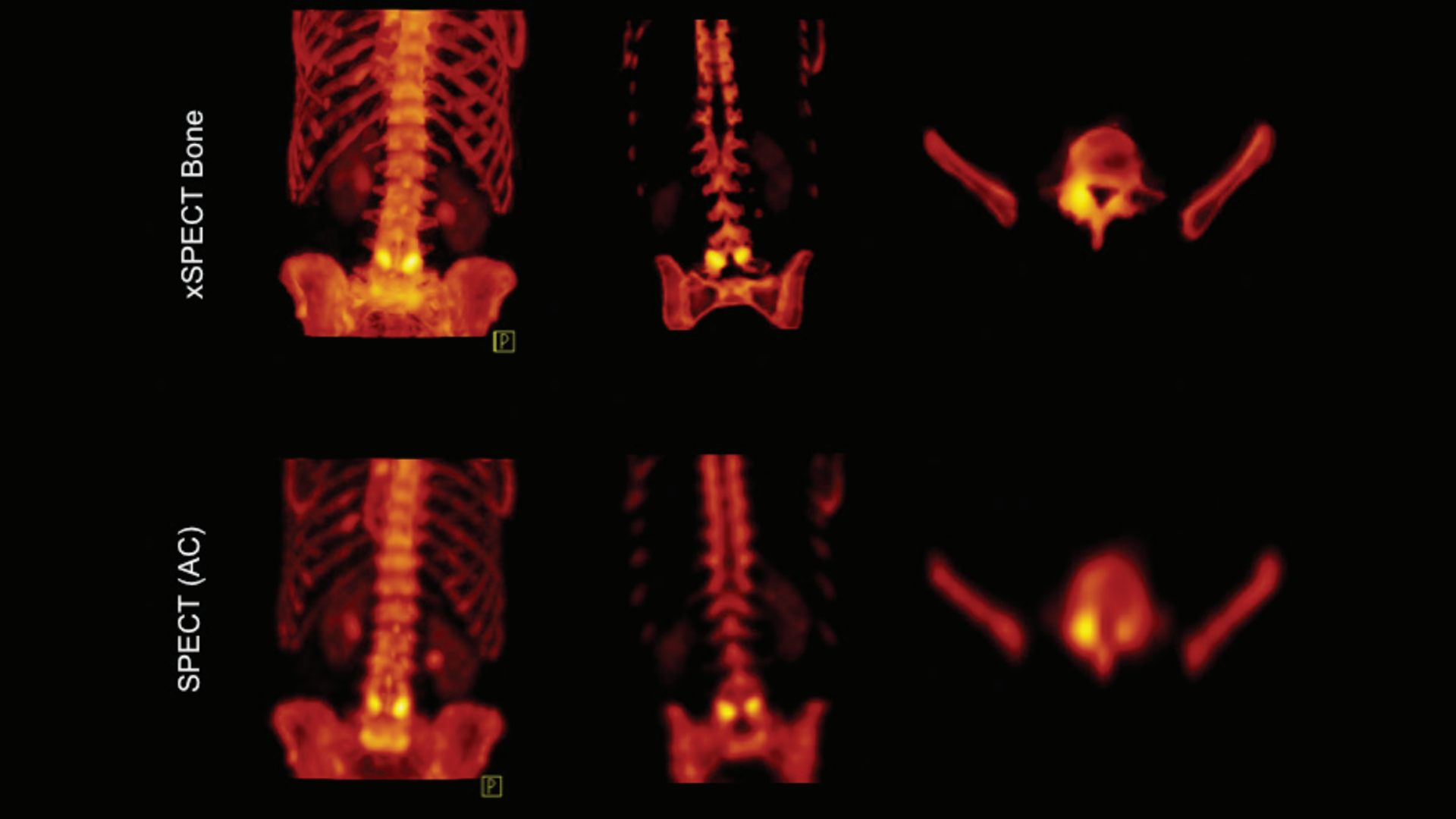 xSPECT Bone - Siemens Healthineers