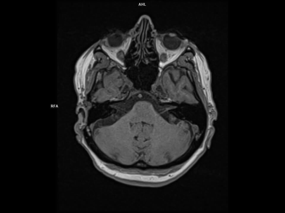 Axial T1 VIBE CAIPI-MAGNETOM Altea