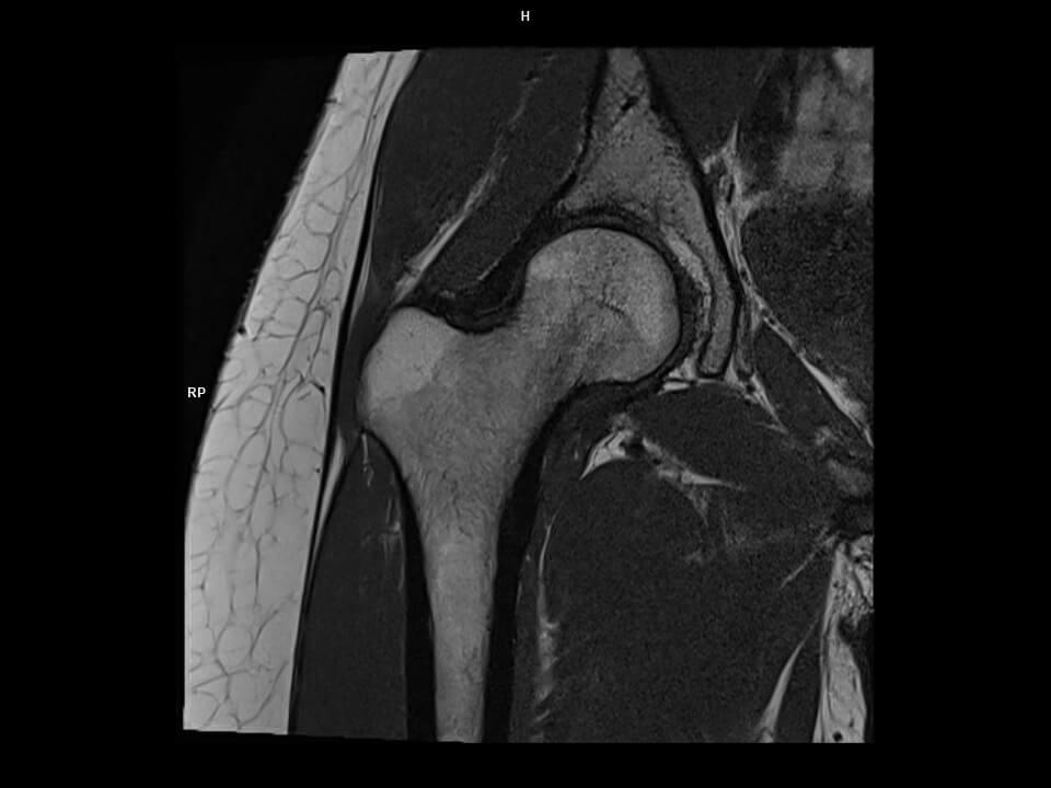 Coil-UltraFlex18 Large/Resolution-416/Scan Time-1:00/Aceleration-s2