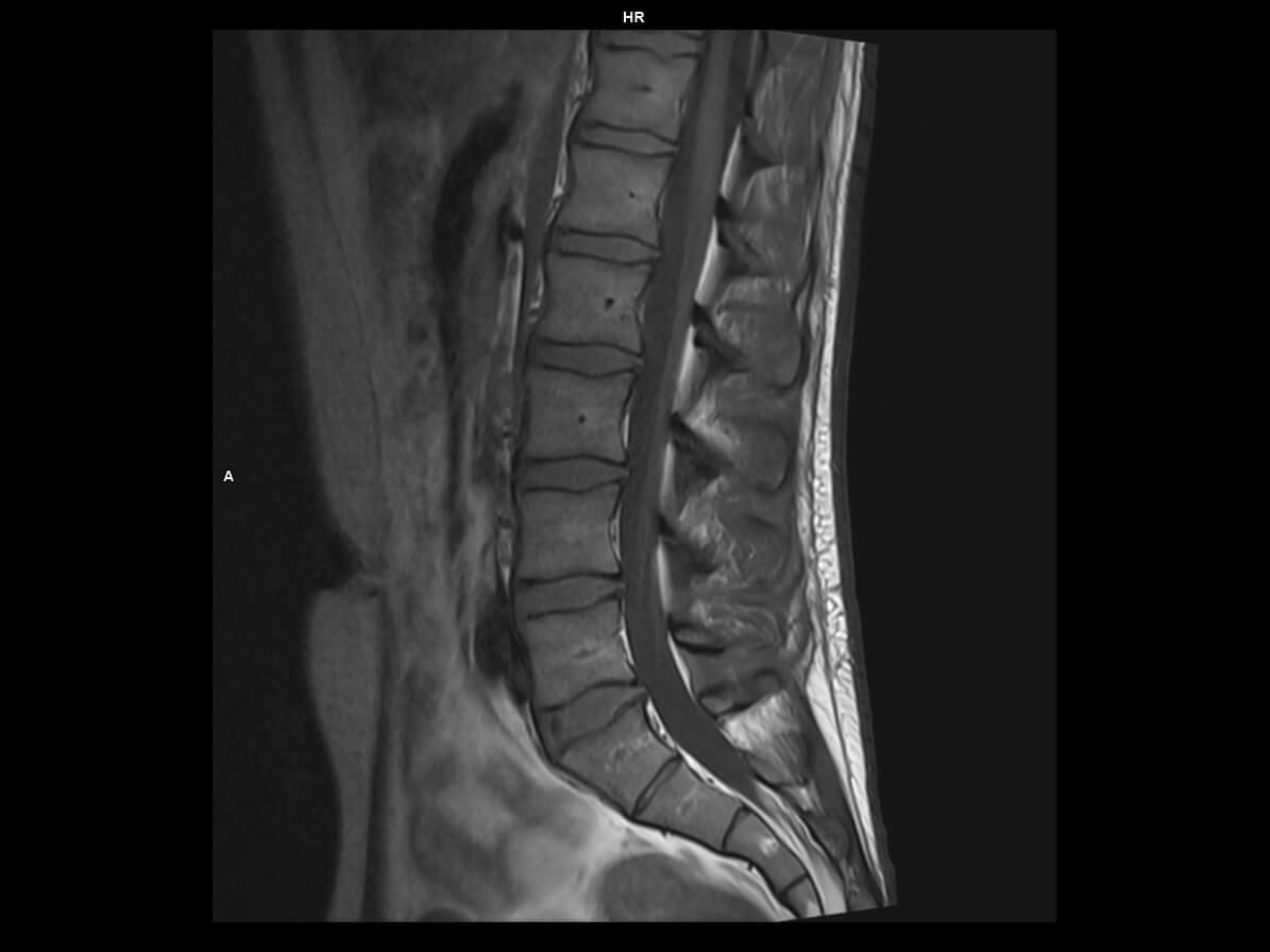 Sagittal T1 tse-MAGNETOM Altea