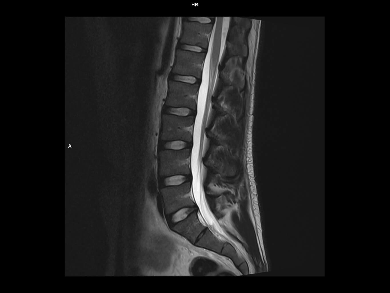 Sagittal T2 tse-MAGNETOM Altea