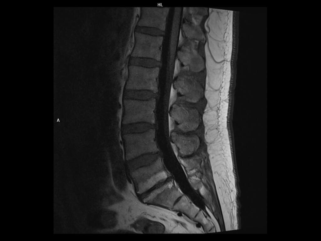 Sagittal T1 tse-MAGNETOM Altea