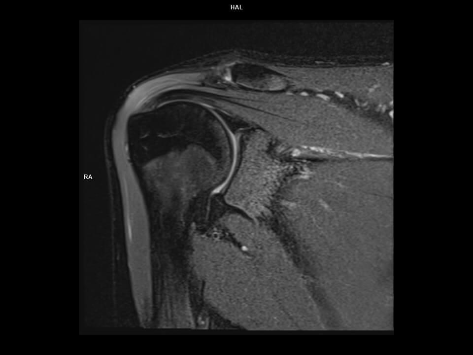Coronal PD tse FS-MAGNETOM Altea