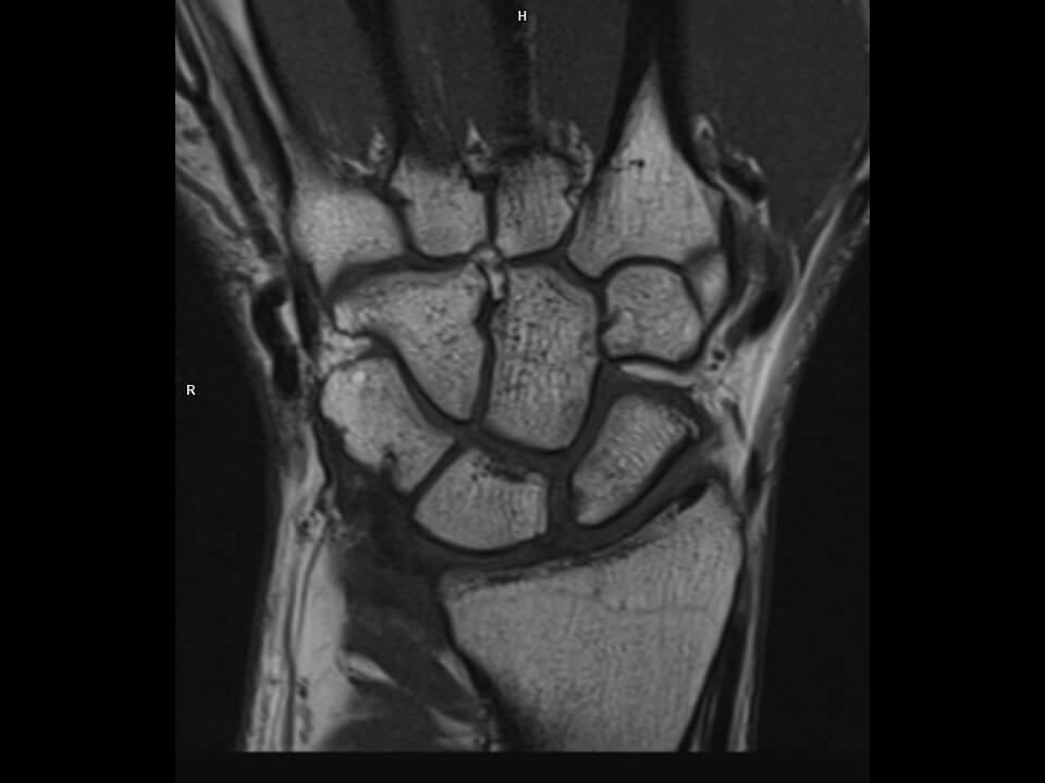 Coronal T1 tse-MAGNETOM Altea