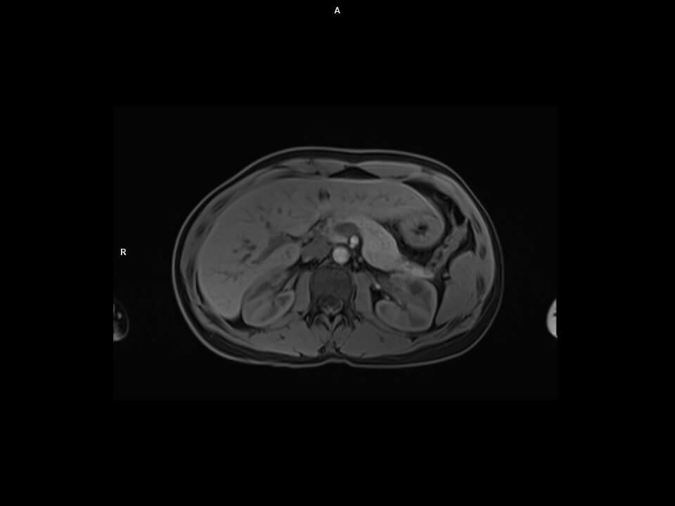Axial T1 VIBE Dixon CAIPI-MAGNETOM Altea