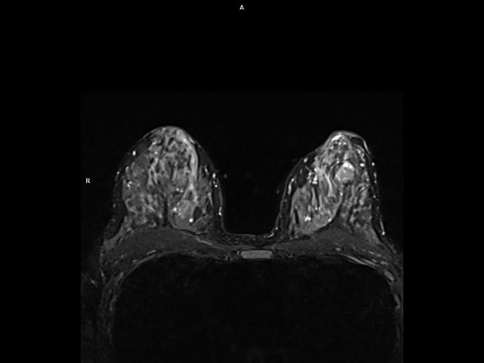 Axial T2 Dixon-MAGNETOM Altea