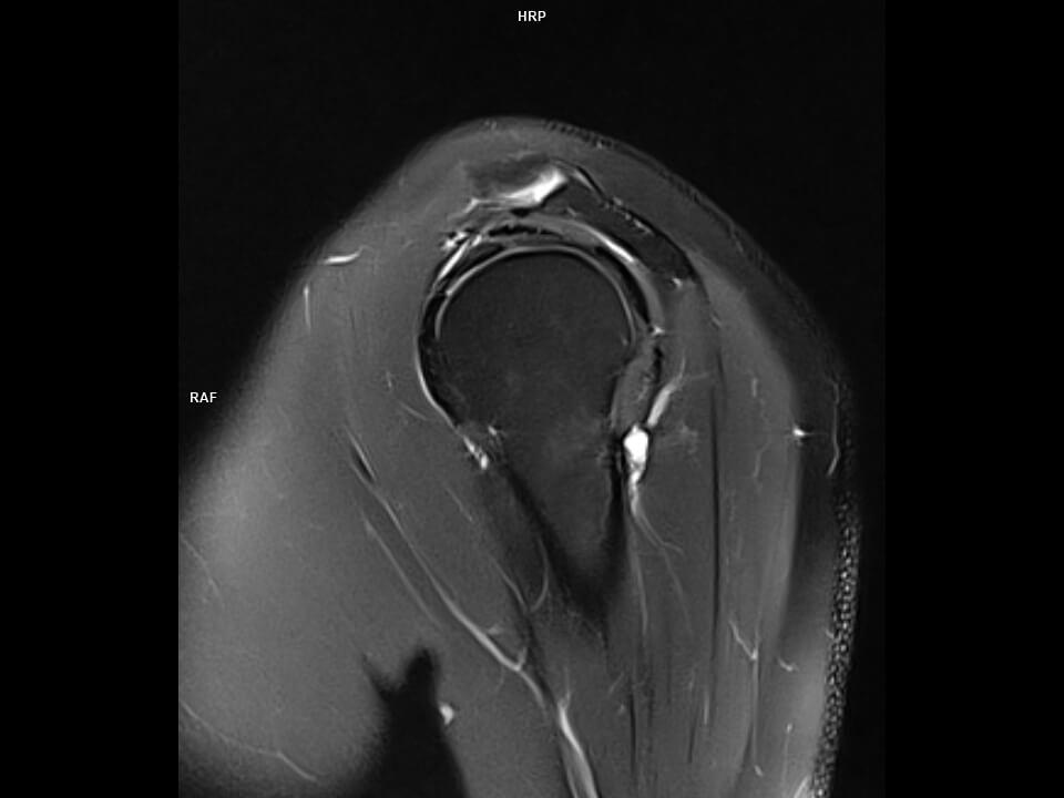 Sagittal T2 FS BLADE-MAGNETOM Altea