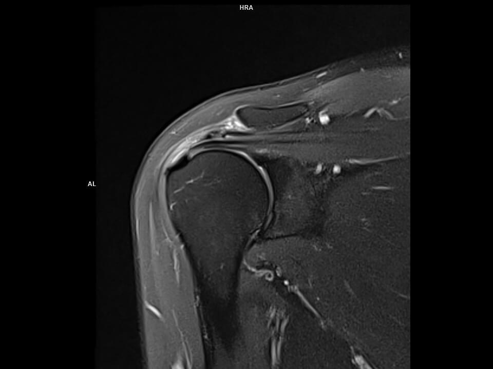 Coronal T2 FS BLADE-MAGNETOM Altea