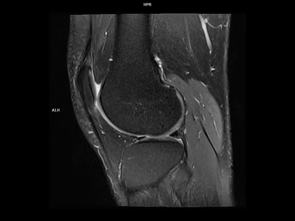 Sagittal PD tse FS-MAGNETOM Altea