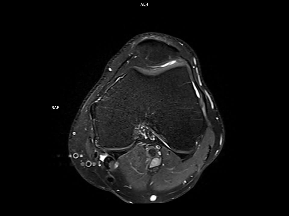 Axial PD tse FS-MAGNETOM Altea
