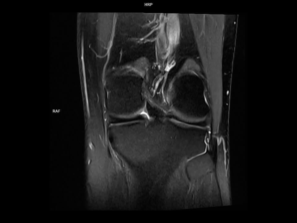 Coronal PD tse FS-MAGNETOM Altea