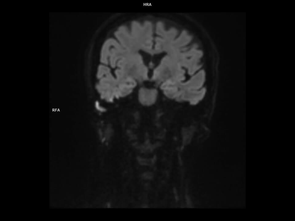 Coronal DIFF RESOLVE 800b-MAGNETOM Altea