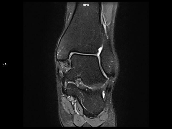 PD FS Cor-MAGNETOM Sola
