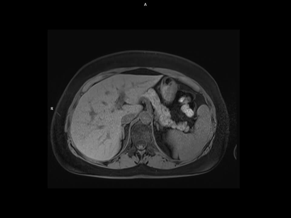 Axial T1 VIBE-MAGNETOM Sola