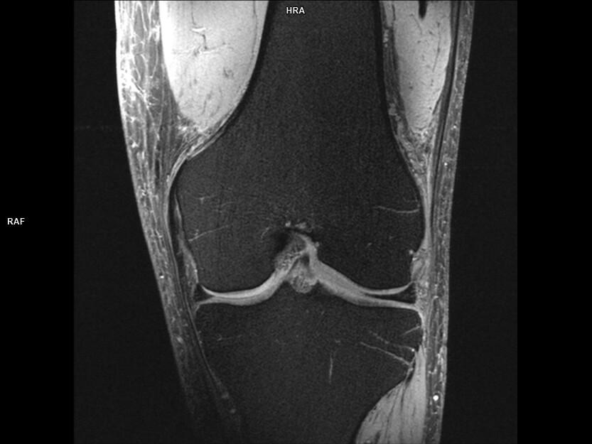 Coronal T1 TSE FS-MAGNETOM Terra