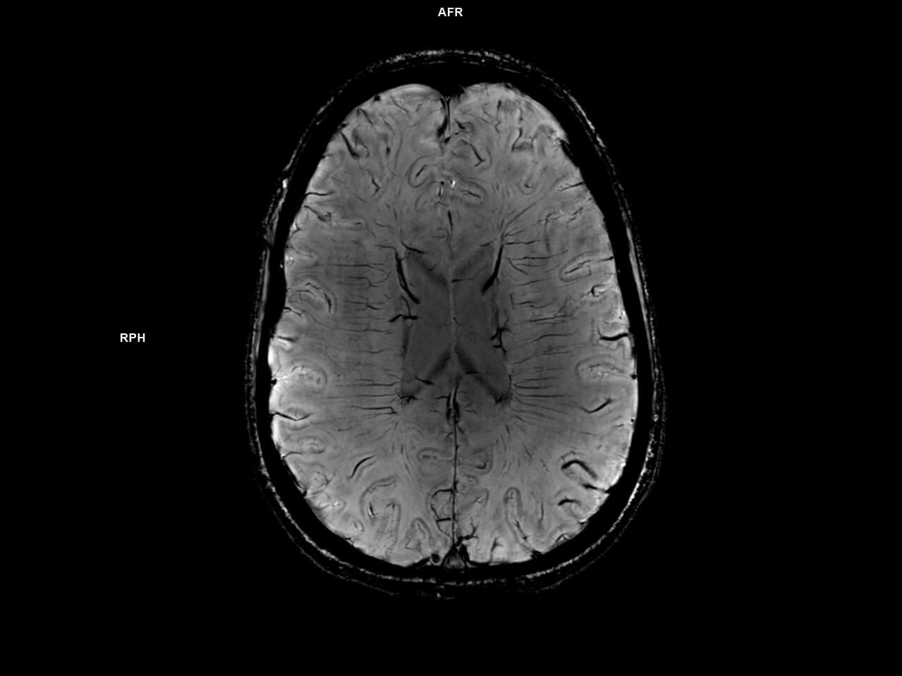 Axial SWI-MAGNETOM Terra