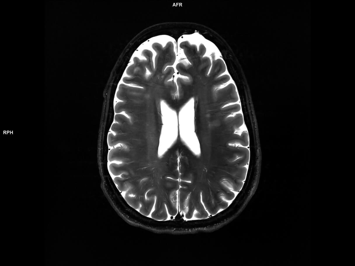 Axial T2 TSE-MAGNETOM Terra