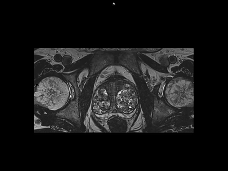 AXIAL 3D T2 SPACE ZoomIT-MAGNETOM Vida