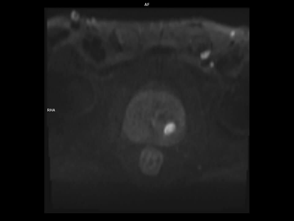 AXIAL EPI DWI_b1000-MAGNETOM Vida