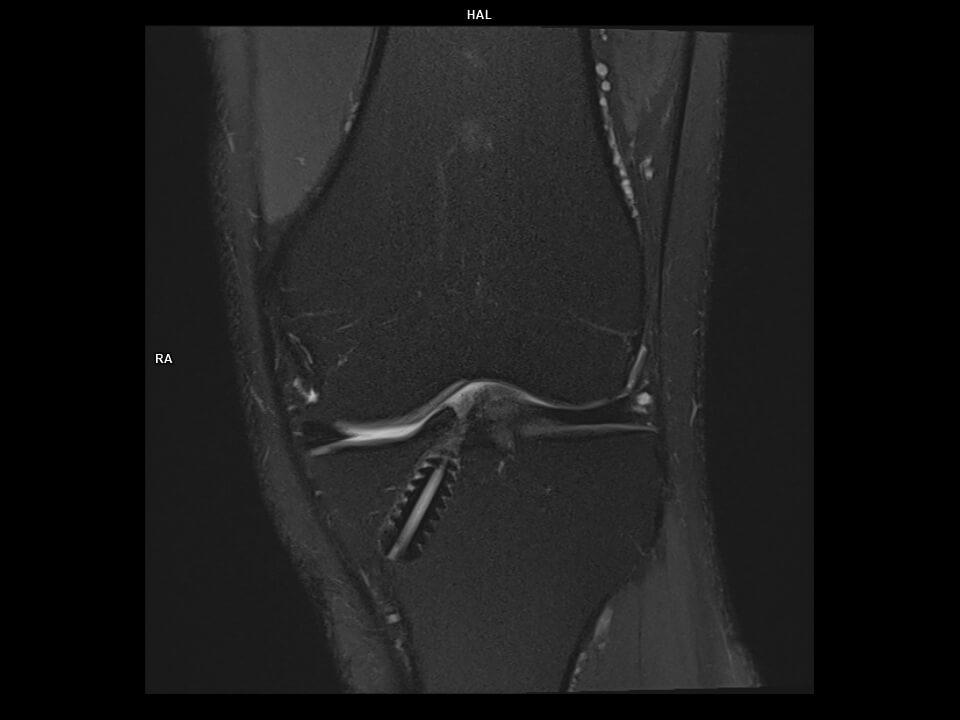 CORONAL PD FS TSE-MAGNETOM Vida