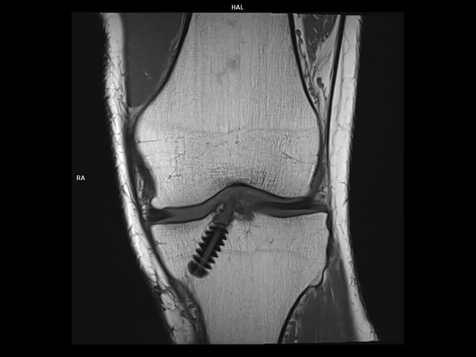 CORONAL T1 TSE-MAGNETOM Vida