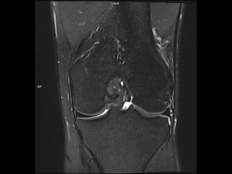 CORONAL PD FS TSE-MAGNETOM Vida
