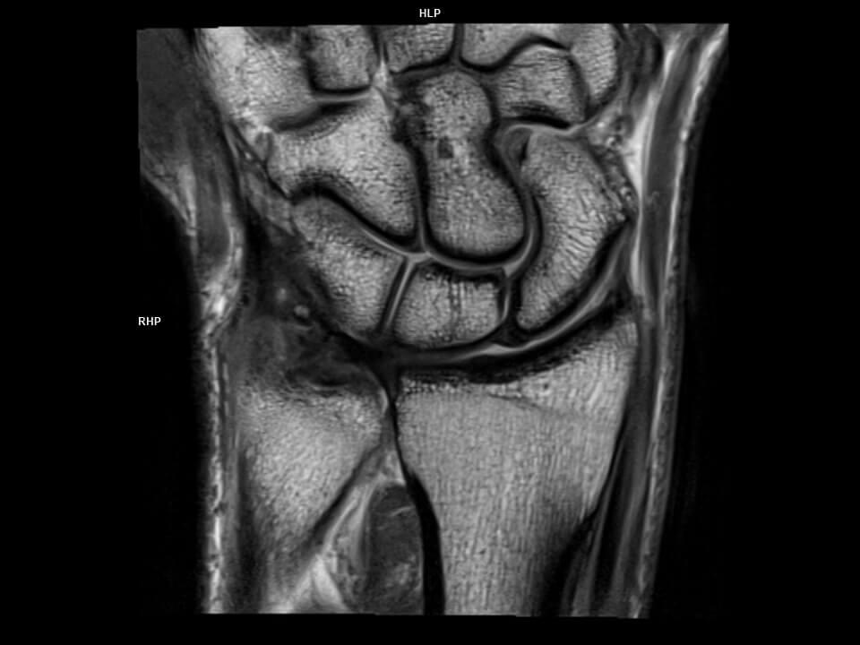 CORONAL PD TSE-MAGNETOM Vida