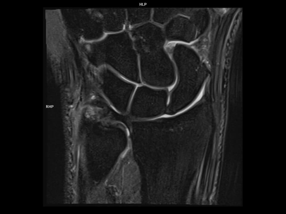 CORONAL PD FS TSE-MAGNETOM Vida
