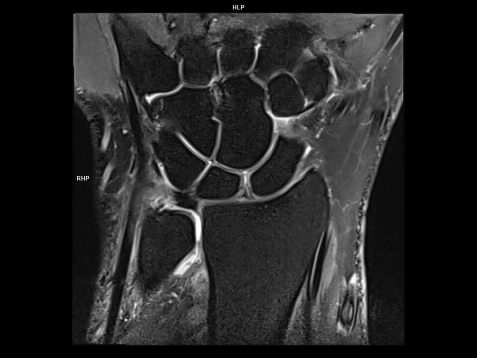 CORONAL PD FS TSE-MAGNETOM Vida
