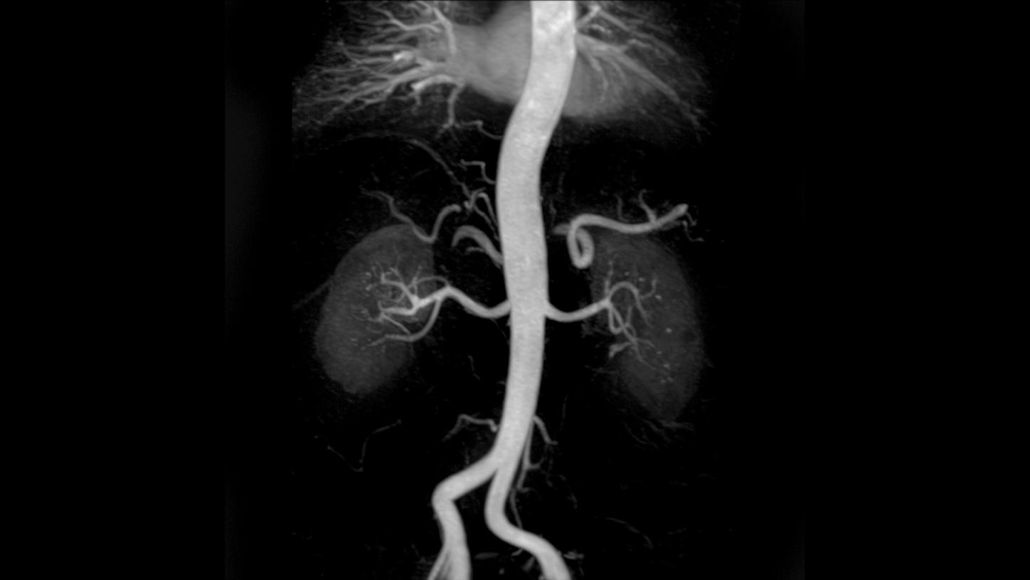 Angiography:<br />3D FLASH CE-MRA, MIP, GRAPPA 2