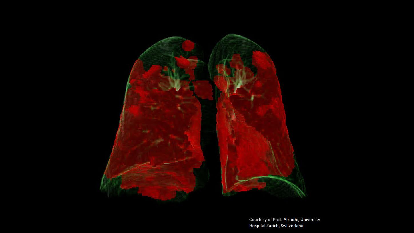 Case 2: post processing performed with syngo.via, Courtesy of Prof. Alkadhi, University Hospital Zurich, Switzerland