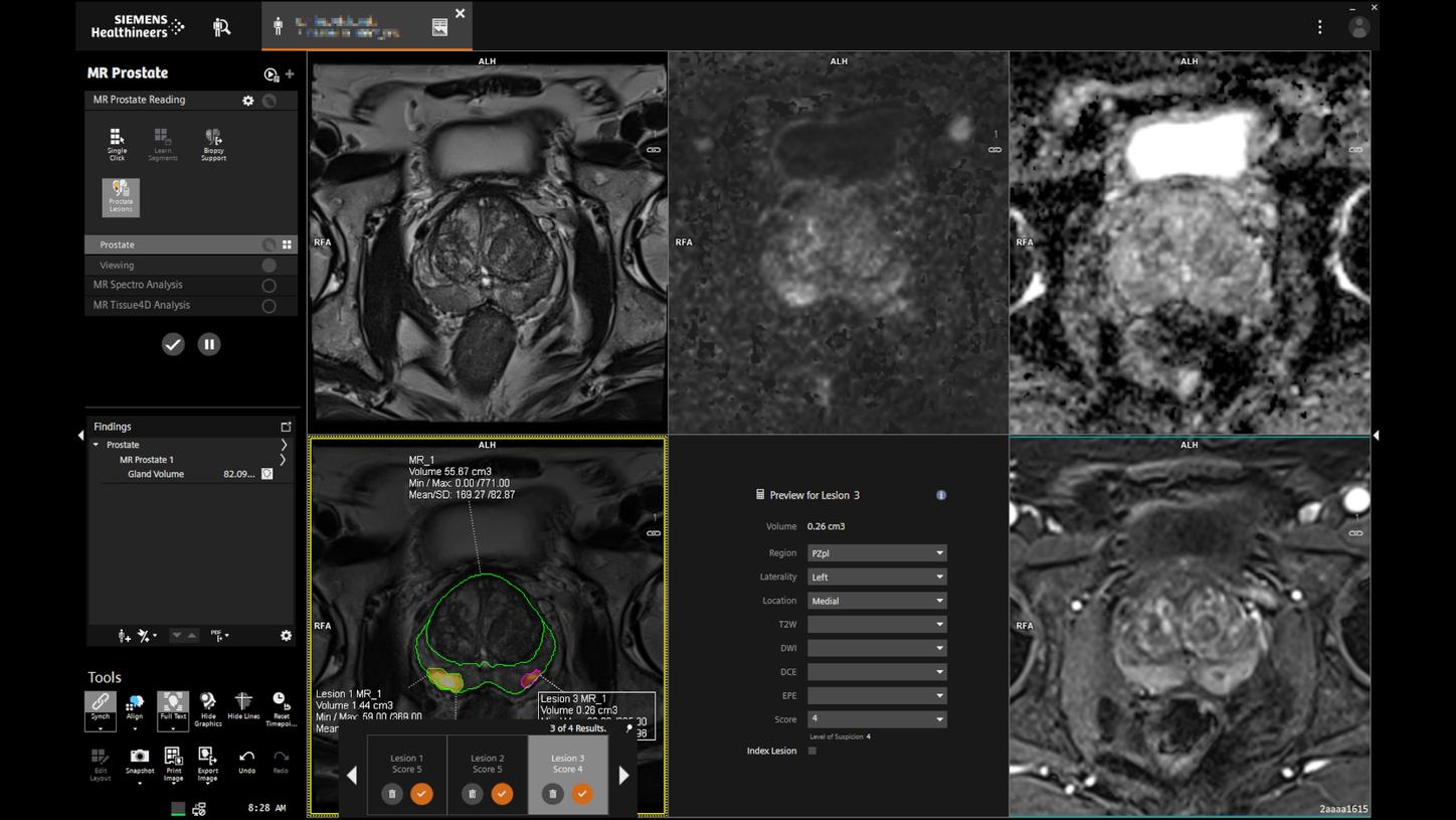 Siemens - MRI - Prostate MRI - PI-RADS report