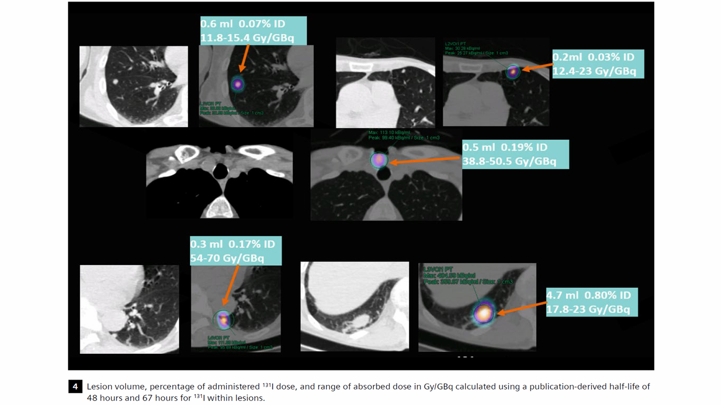 Lesion volume, percentage of administered 131I dose, and range of absorbed dose in Gy/GBq