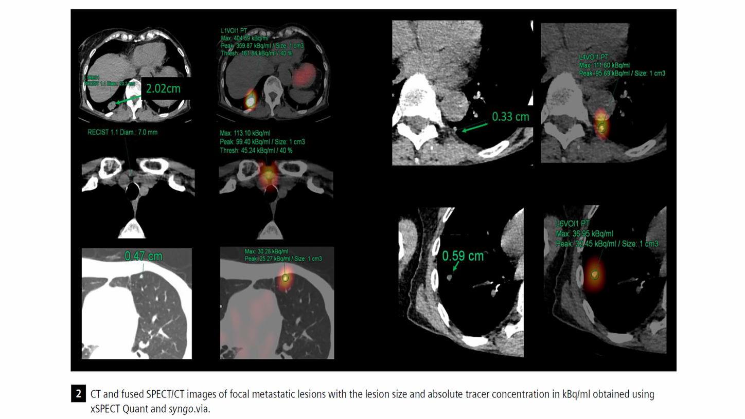 CT and SPECT/CT images of focal metastatic lesions using xSPECT Quant and syngo.via