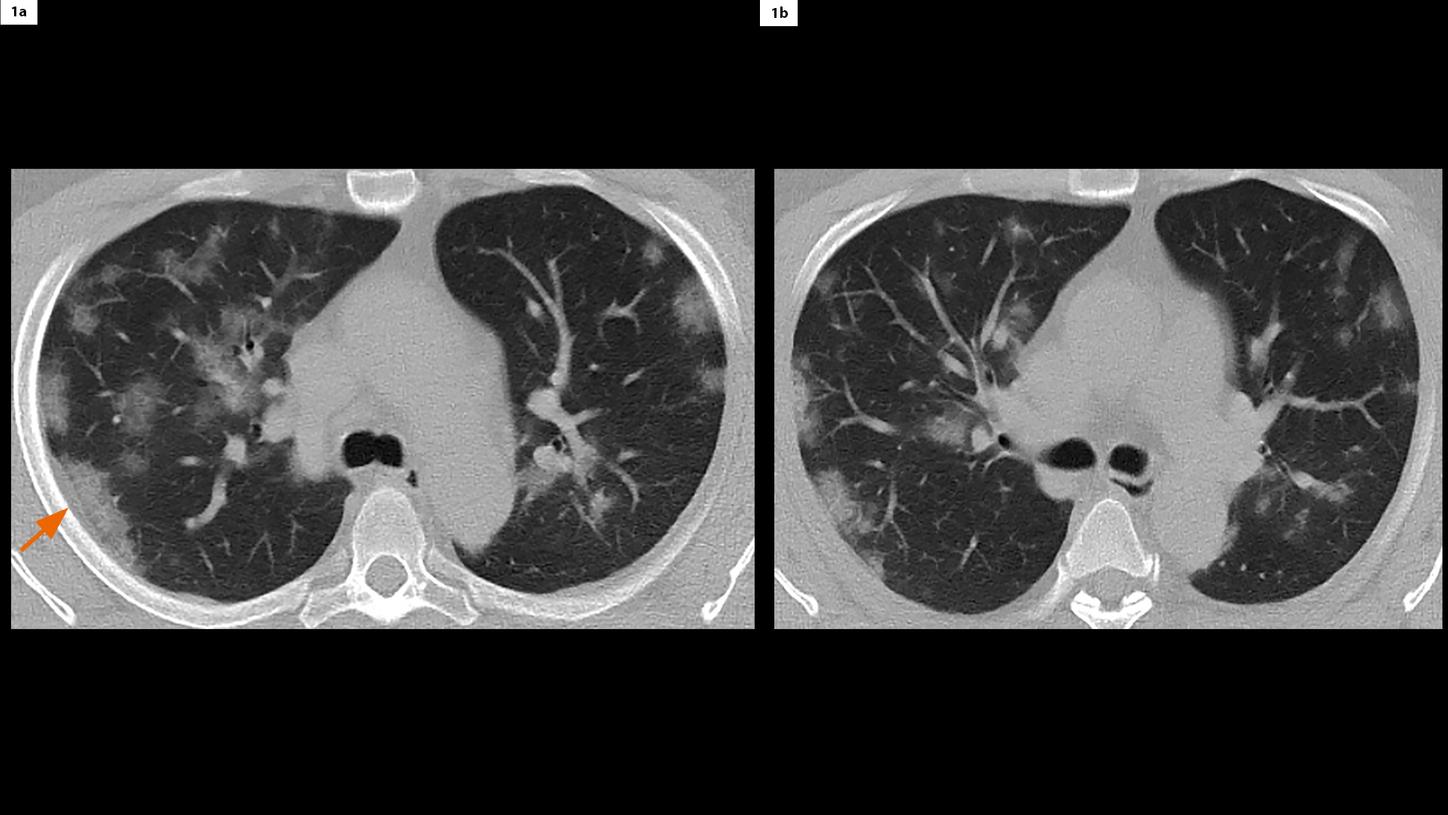 Peripheral and central distribution of patchy GGO bilaterally in the lungs and pleural thickening