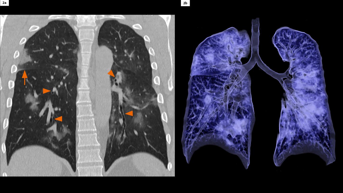 GGO múltiplo em todos os lobos de ambos os pulmões. Sinais de parede brônquica e espessamento septal da fissura horizontal direita