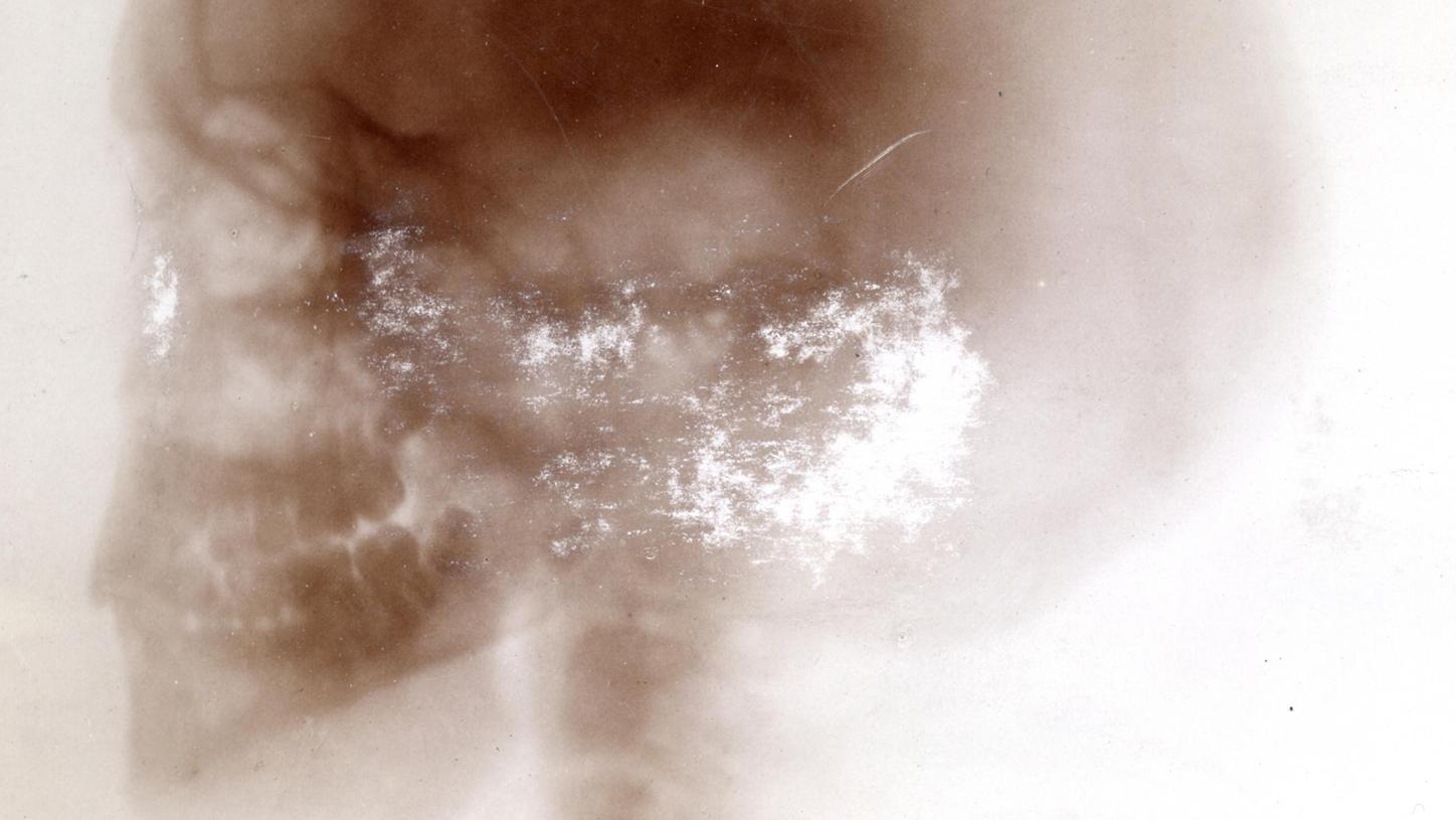 Röntgenfoto van het hoofd van een levend 16 jarig meisje uit 1896.