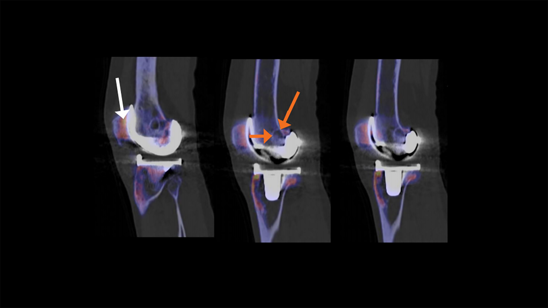 Prosthetic metallic artifact reduction