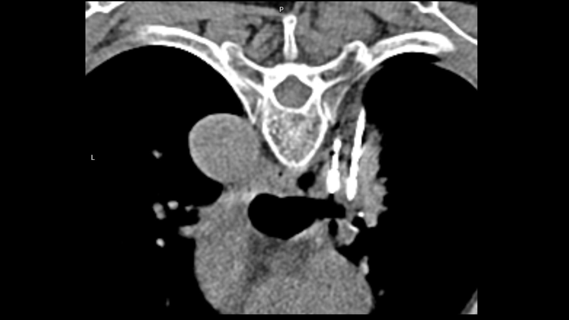 Diagnosis and treatment of lung cancer - Siemens Healthineers Finland