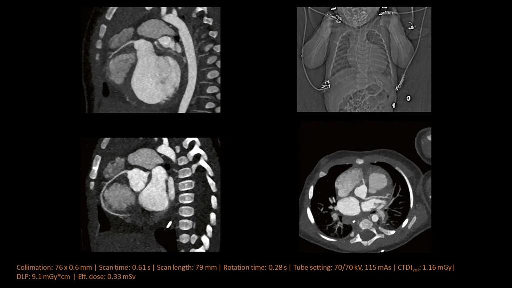 CT Scanner - SOMATOM Force
