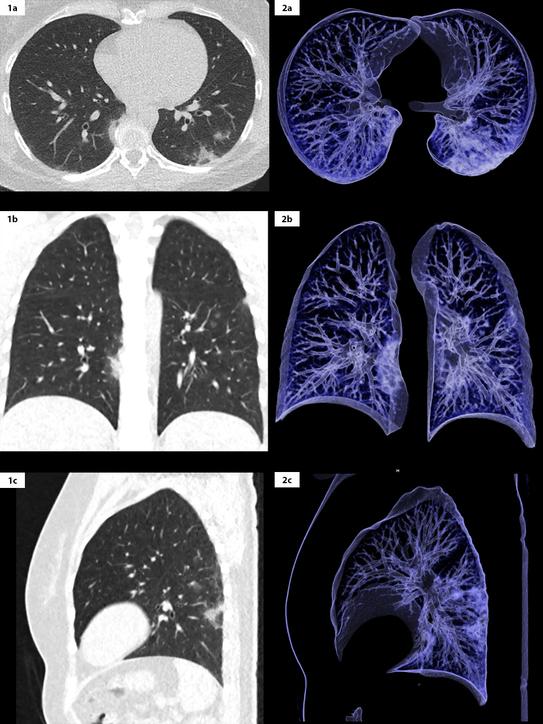 COVID19 pneumonia Chest Xray or CT? Siemens Healthineers