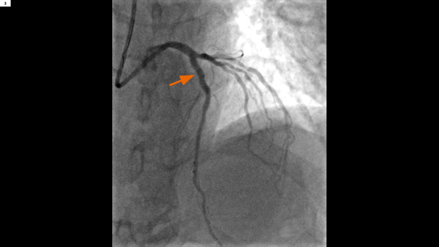 A post-PCI image show a well recanalized LAD in the proximal segment.