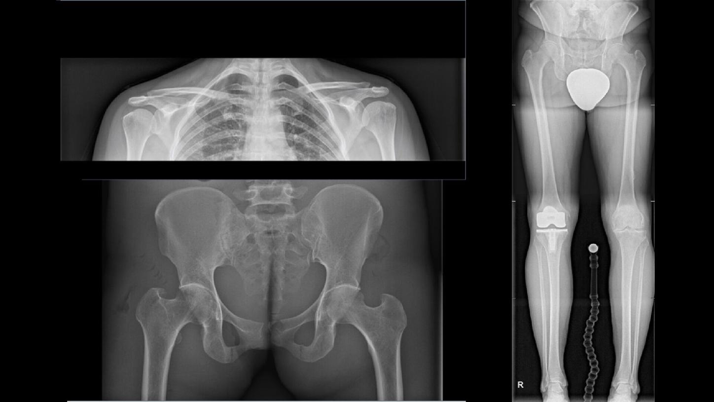 Orthopedic imaging on Multitom Rax with RAXortho and SmartOrtho