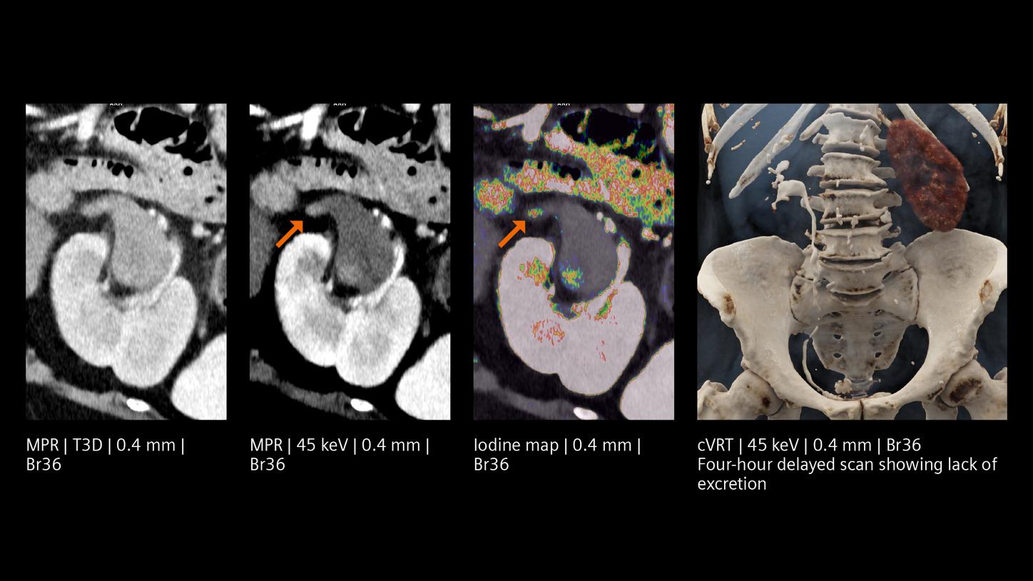 Clinical image of a kidney applying inherently available spectral information for the evaluation of challenging lesions.