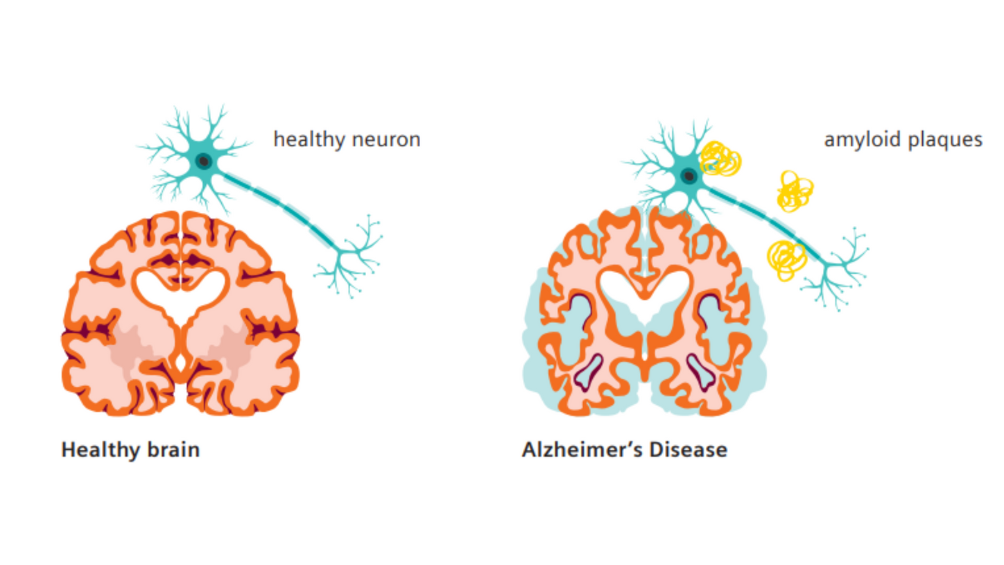 Alzheimer's disease patient poster - image of Alzheimers brain & healthy brain