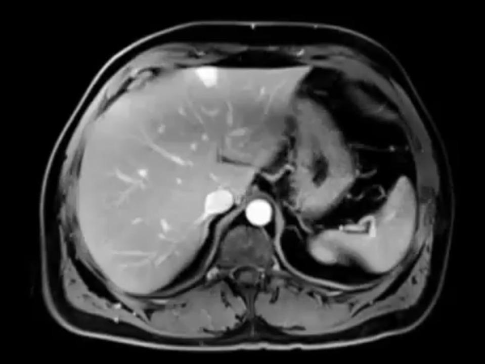 Body MRI - Siemens Healthineers