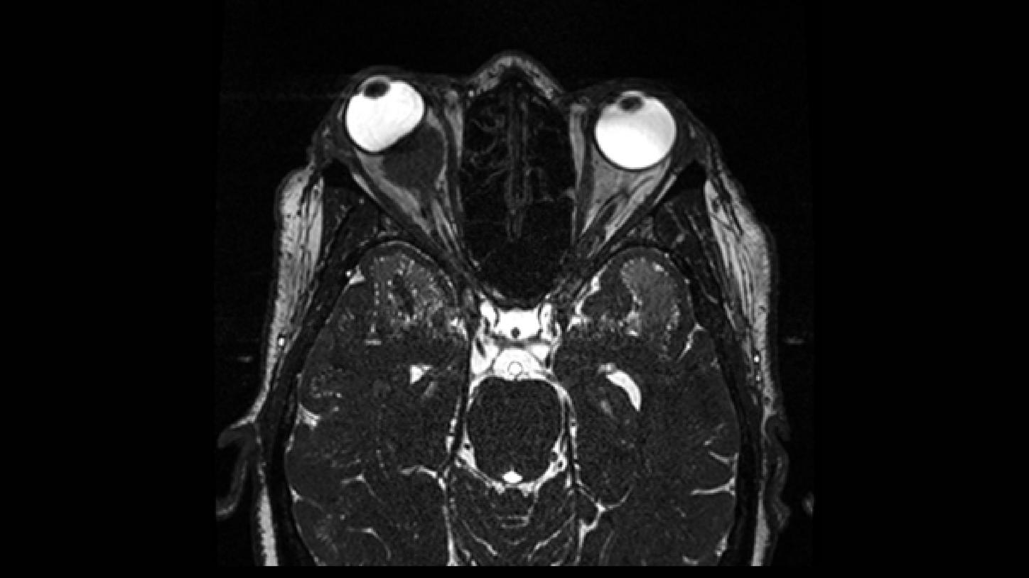 meningioma óptico